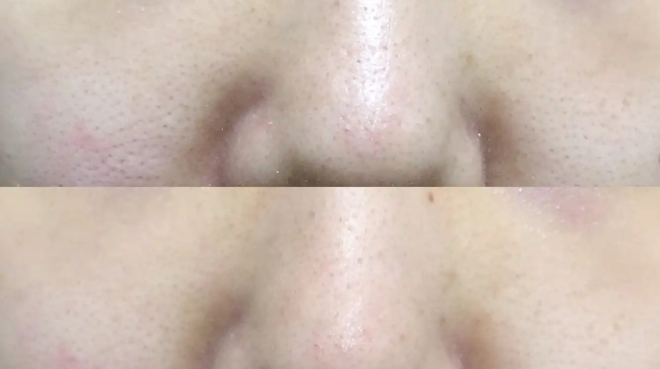 오렌지스킨딜리트 (모공딜리트)