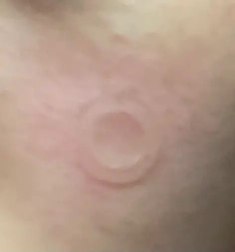 선택된 언니의파우치 리뷰 이미지 - [니들리 패치 안티트러블 겟 리드 오브]