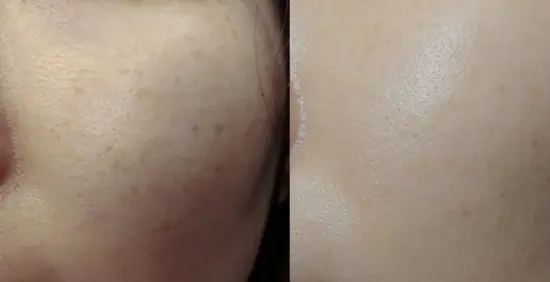 선택된 언니의파우치 리뷰 이미지 - [닥터미라클 퍼펙트 멜라케어 패치 (패치&크림 세트구성)]