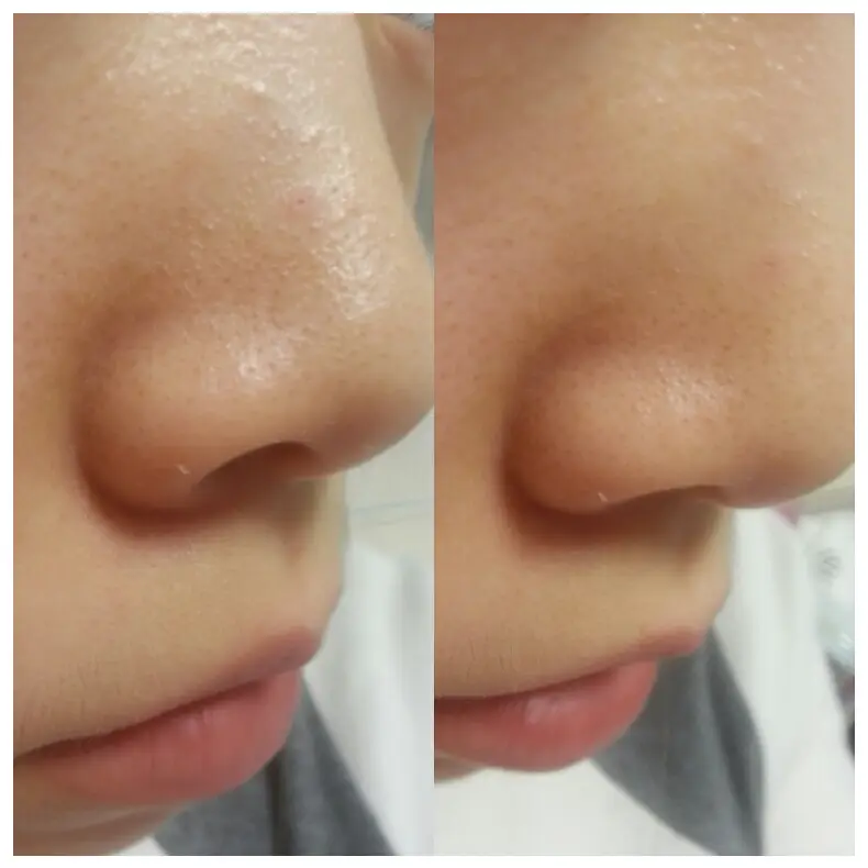 선택된 언니의파우치 리뷰 이미지 - [블랙헤드 숨바꼭질 미코 클렌징 솝]