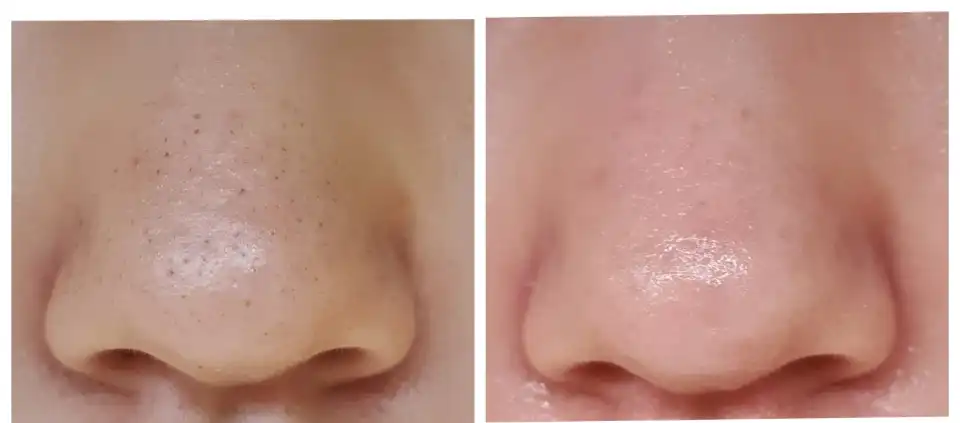 언니의파우치 리뷰 이미지 12 - [안티 포어 블랙헤드 클리어 키트]