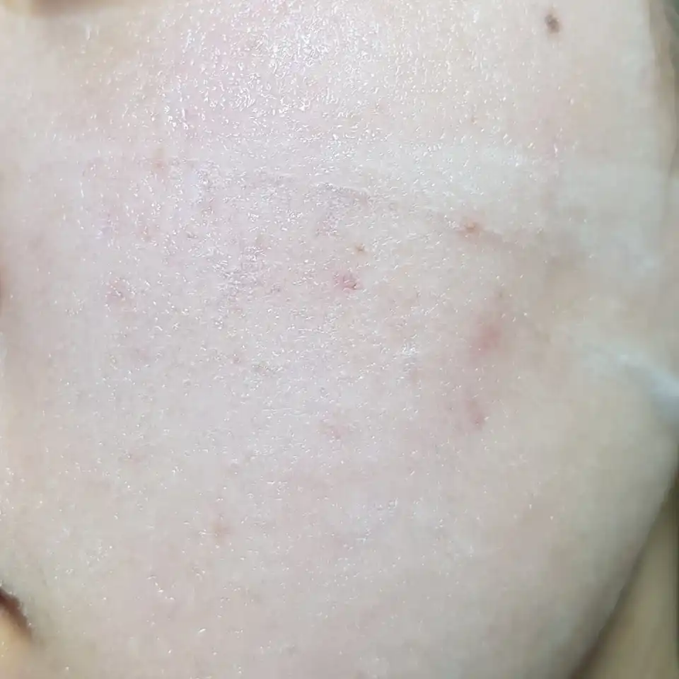 히알론 모이스트 액티브 씰 마스크