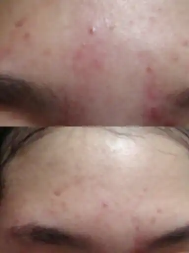 진액 캡슐 팩-비자&티트리