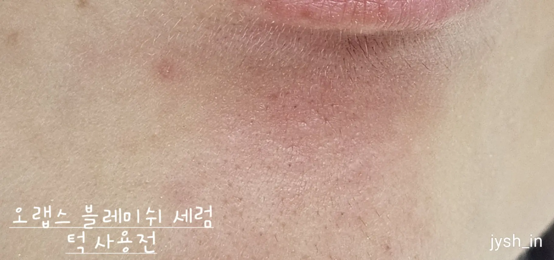 선택된 언니의파우치 리뷰 이미지 - [블레미쉬 케어 세럼]