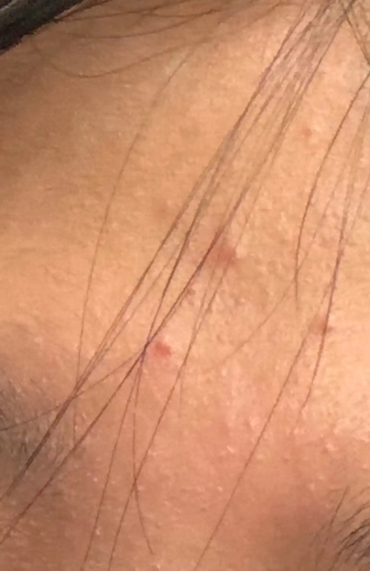 어성초 77 클리어 패드