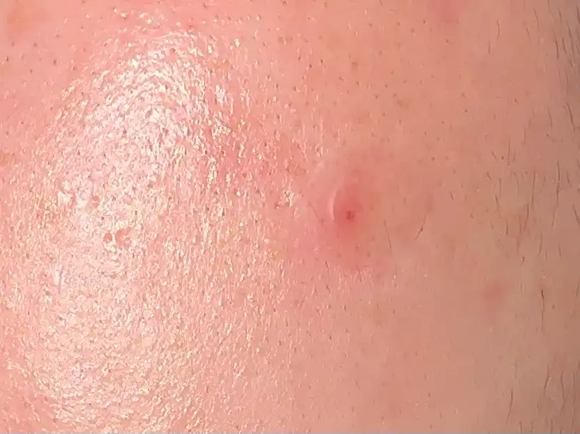 언니의파우치 리뷰 이미지 5 - [티트리 시카 SOS 스팟패치]