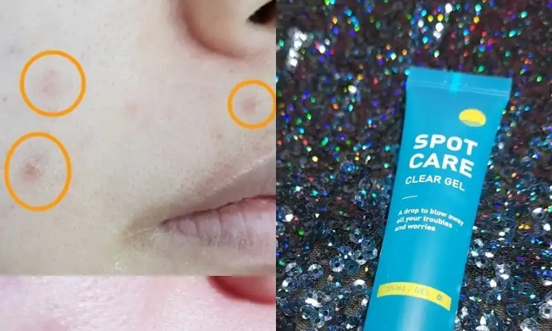 스팟케어 클리어 젤