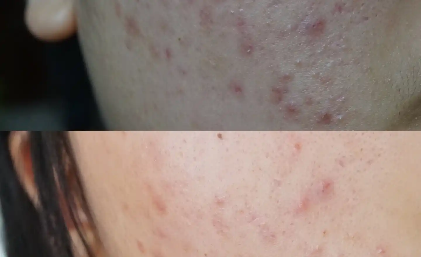 아크니 닥터 1st 스피디 스팟 [파란소화기 응급스팟]