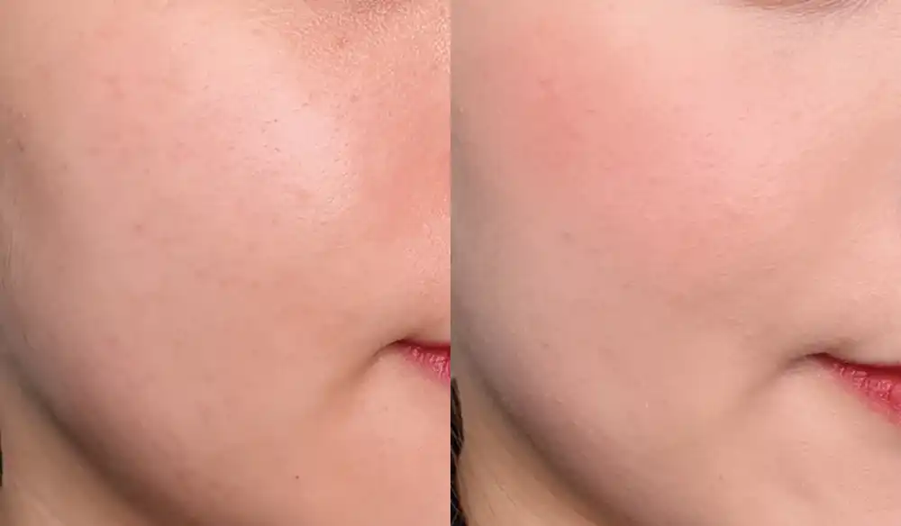 스키니 픽스 블렌더